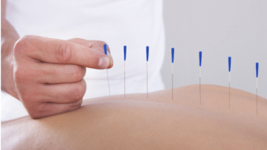 Acupuncture